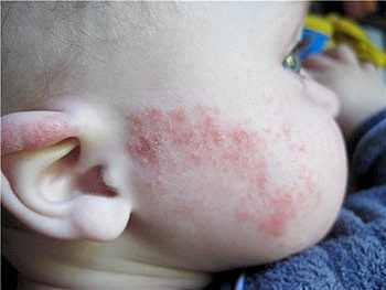 аллергия на мед у ребенка лечение