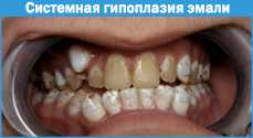 гипоплазия постоянных зубов у детей развивается в период