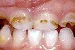 Гипоплазия постоянных зубов у детей развивается в период