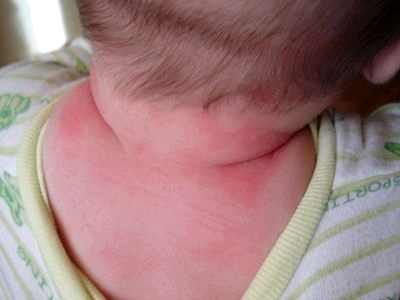 признаки бронхита у детей комаровский