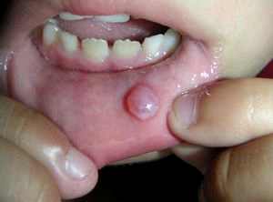 Ребенок прикусил губу изнутри лечение