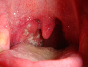 Вирусное заболевание горла у детей фото