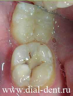 лечение зубов под наркозом детям красноярск