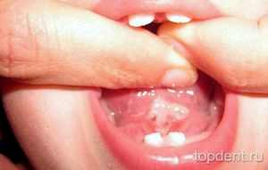 Приросший язык у ребенка симптомы