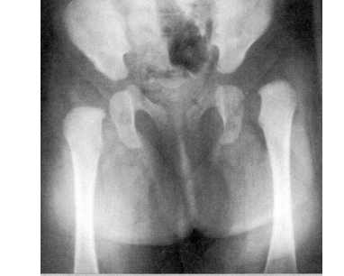 рентгеновские снимки тазобедренного сустава детей