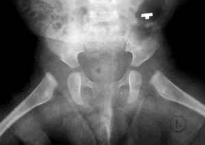 Рентгеновские снимки тазобедренного сустава детей