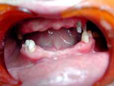 кариес временных зубов у детей лечение
