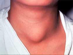 Щитовидная железа у детей 7 лет