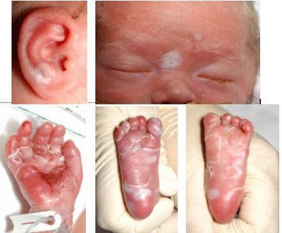 Врожденный гипотиреоз у детей симптомы