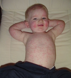 температура при ротовирусе у ребенка