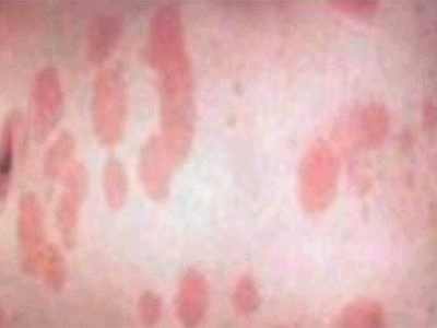 аллергия на глютен у ребенка симптомы