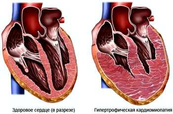 гипертрофическая кардиомиопатия у детей лечение