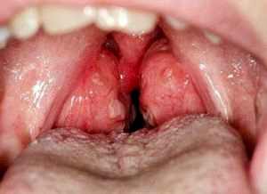 Гипертрофия небных миндалин у детей симптомы