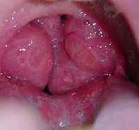 гипертрофия небных миндалин у детей симптомы