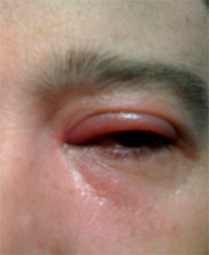 лечение воспаления глаз у детей