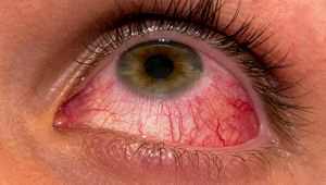 Лечение воспаления глаз у детей