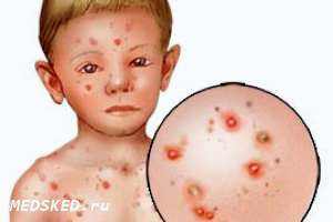 первые признаки менингита у детей 7 лет