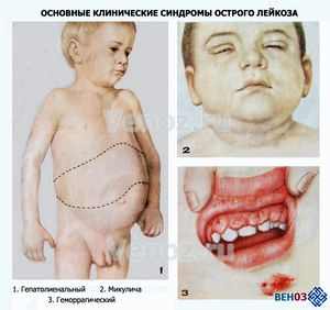 Проявления лейкоза у детей