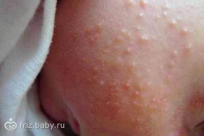 аллергия на казеин у ребенка до года