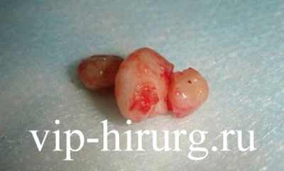 фурункул в ухе у ребенка лечение фото