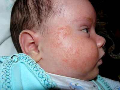 Как выглядит аллергия у детей на лице