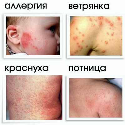 признаки аллергии у взрослых фото