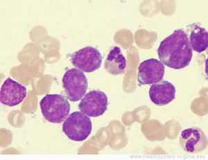 острый лейкоз у детей анализ крови