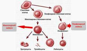 Острый лейкоз у детей анализ крови