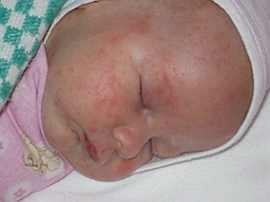 Перхоть у новорожденного ребенка комаровский Консультация педиатра ...