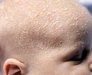 аллергия на голове у ребенка фото