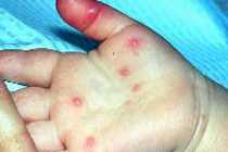 Энтеровирусная инфекция у детей симптомы