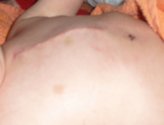 шрам у ребенка после операции на сердце