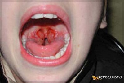 Симптомы гнойной ангины у детей