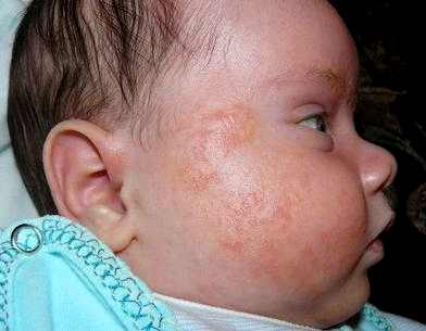 чем опасна аллергия у детей до года