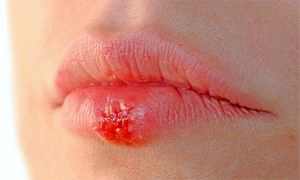 Можно ли заразить ребенка герпесом на губах