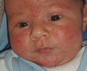 У ребенка пищевая аллергия как лечить