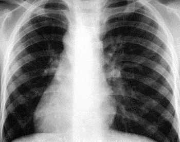 диссеминированный туберкулез легких у детей