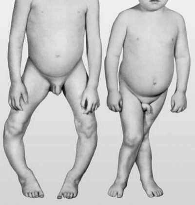 признаки диатеза у грудных детей фото