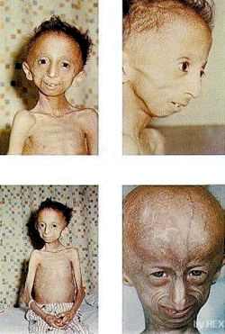 дети больные раком фото до и после
