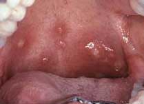 Стоматит у месячного ребенка фото