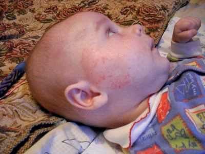 как вылечить диатез у ребенка на щеках