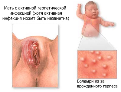 Рыхлые миндалины у ребенка 2 года