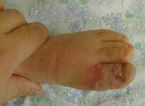 Панариций пальца у ребенка 3 месяца