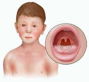 Грибок в горле симптомы и лечение фото у детей
