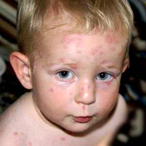 первые симптомы простуды у ребенка