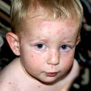 Первые симптомы простуды у ребенка