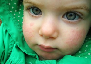 температура при крапивнице у детей лечение