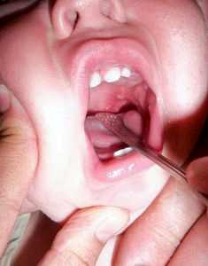 Красное горло у ребенка 10 месяцев лечение