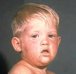 Полиомиелит у детей симптомы и лечение