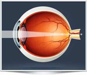 что такое астигматизм глаз у детей